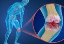 SAÚDE FEMININA – Menopausa e osteoporose: como proteger os ossos